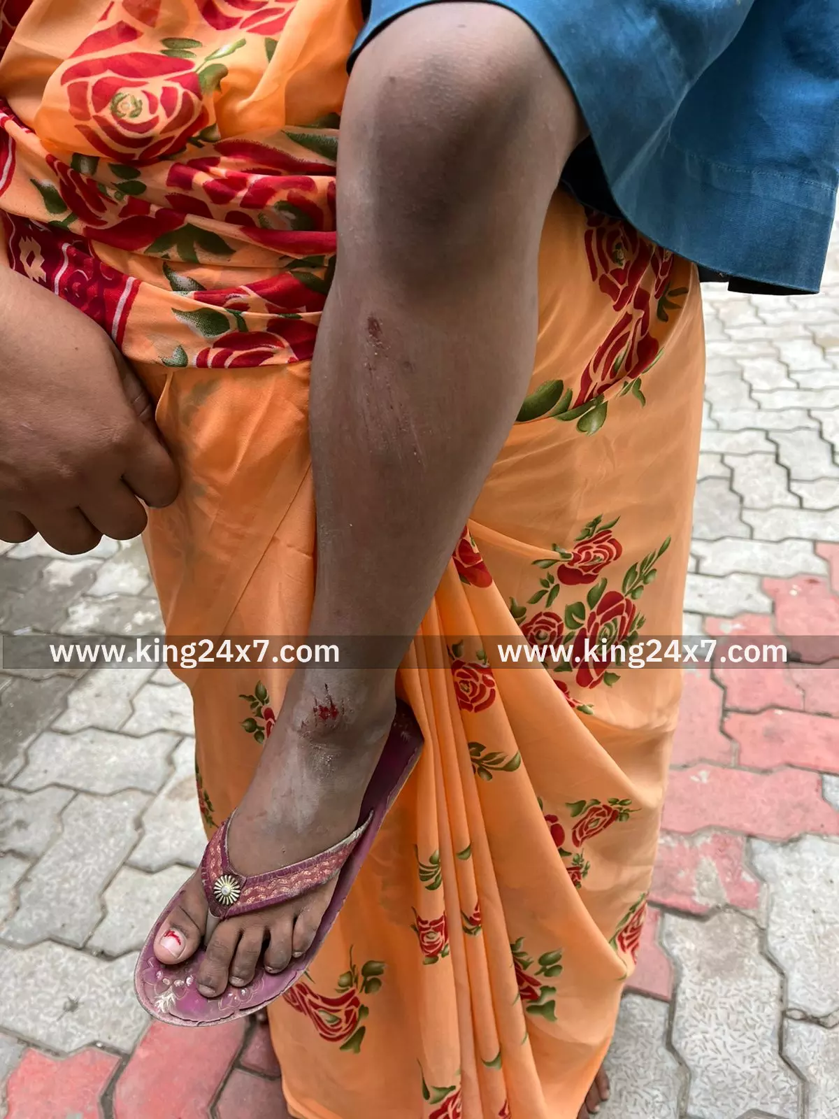 பள்ளி மாணவியை கடித்து குதறிய தெரு நாய்